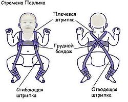 дисплазия тазобедренного сустава и слинг